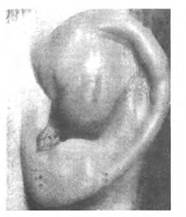 Тема:острые заболевания наружного, среднего уха.